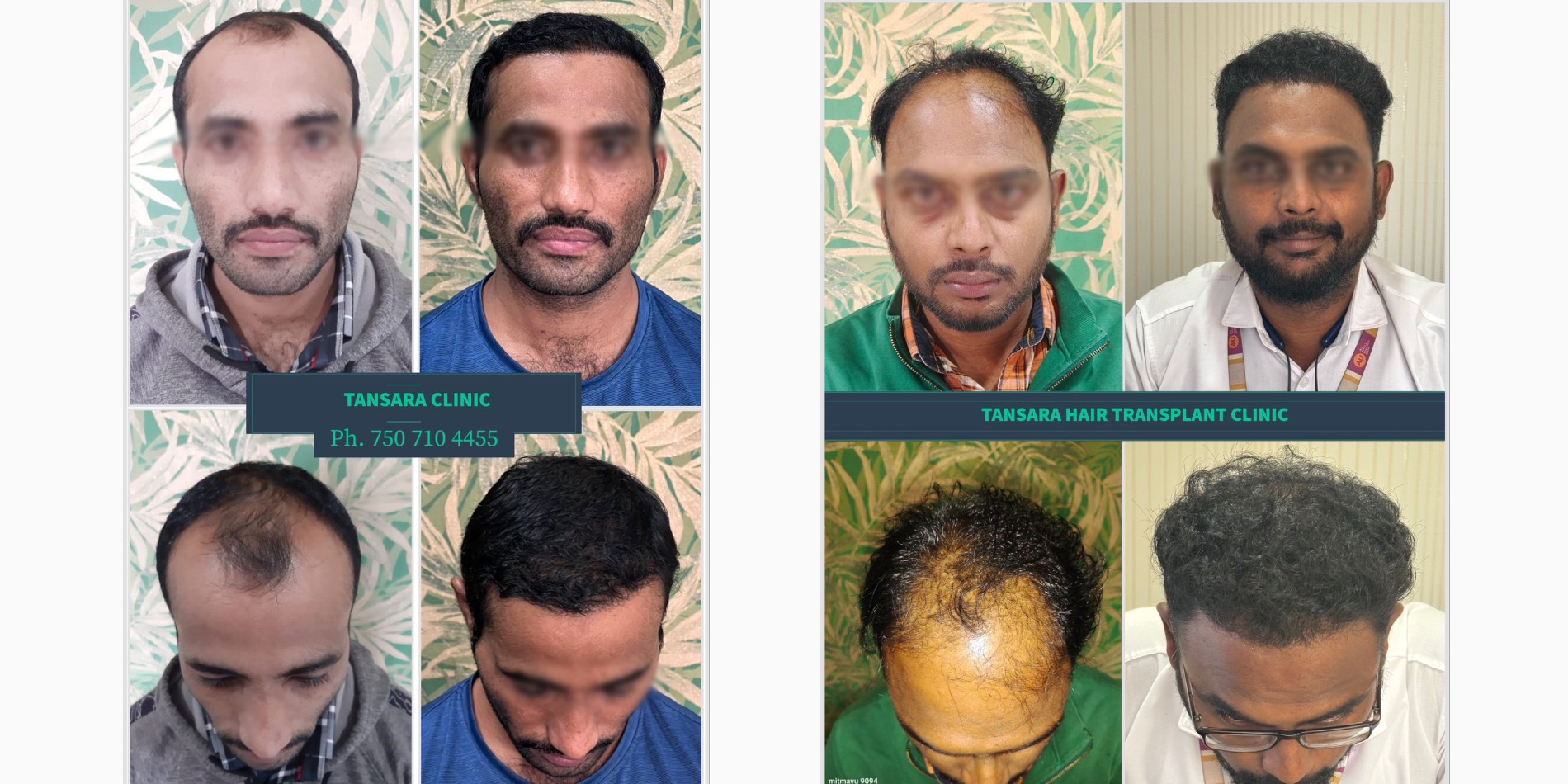 Hair Transplant