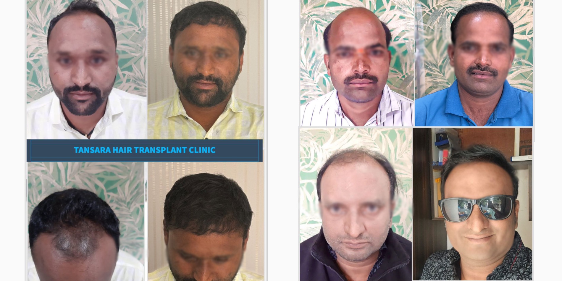 Hair Transplant