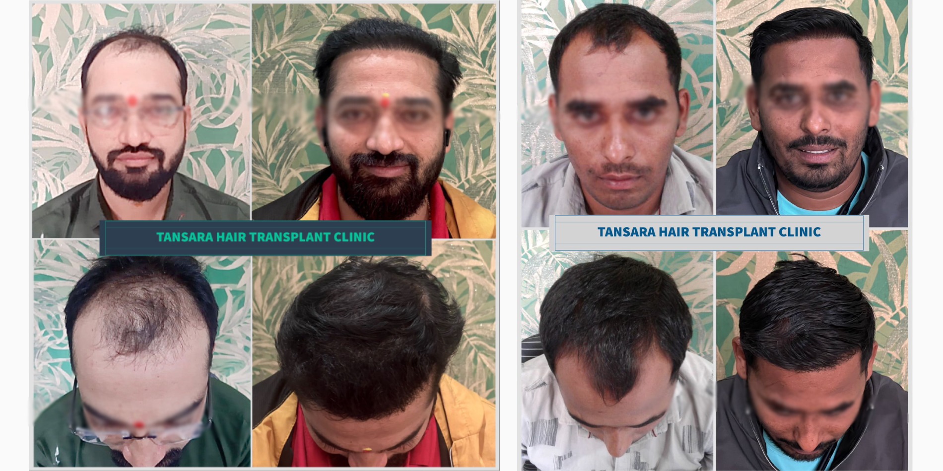 Hair Transplant